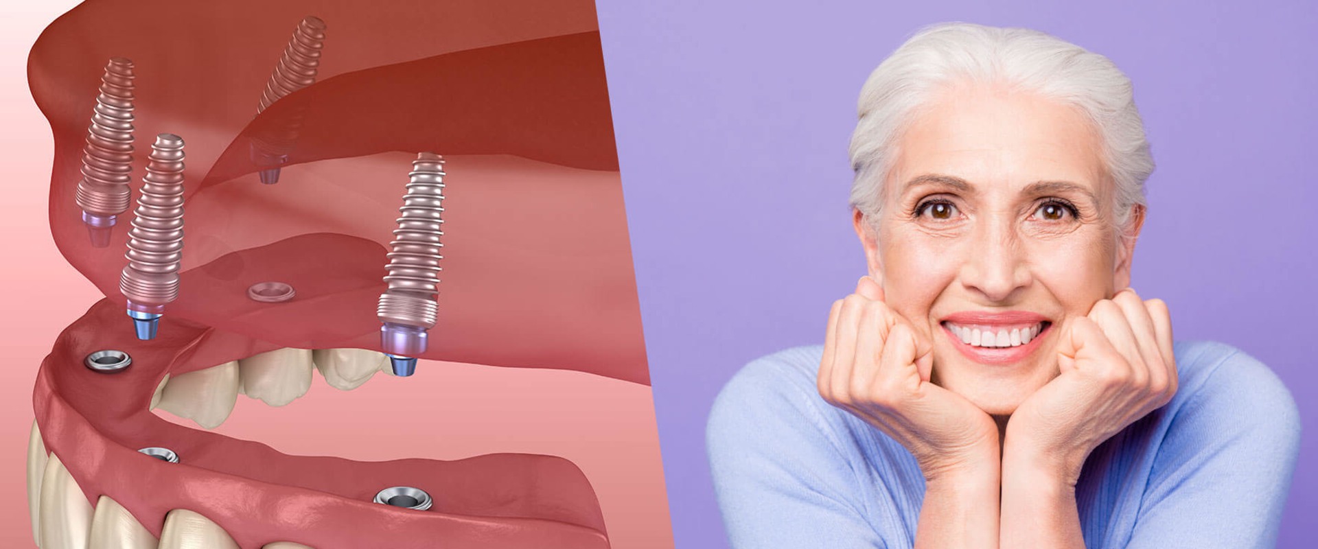 Diagnosis and Preparation for Dental Implants