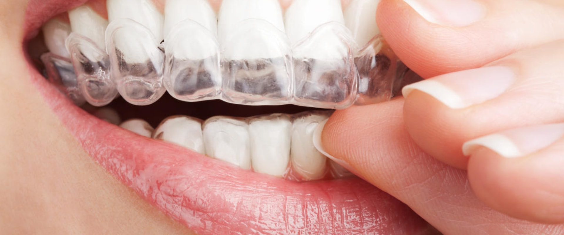 Whitening Strips, Gels, and Pens: A Comprehensive Overview