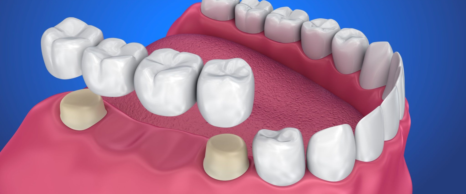 Everything You Need to Know About Crowns and Bridges