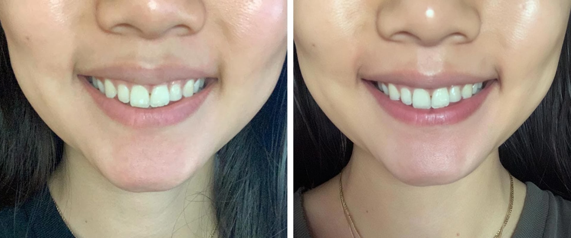 Teeth Whitening with Toothpaste and Mouthwash