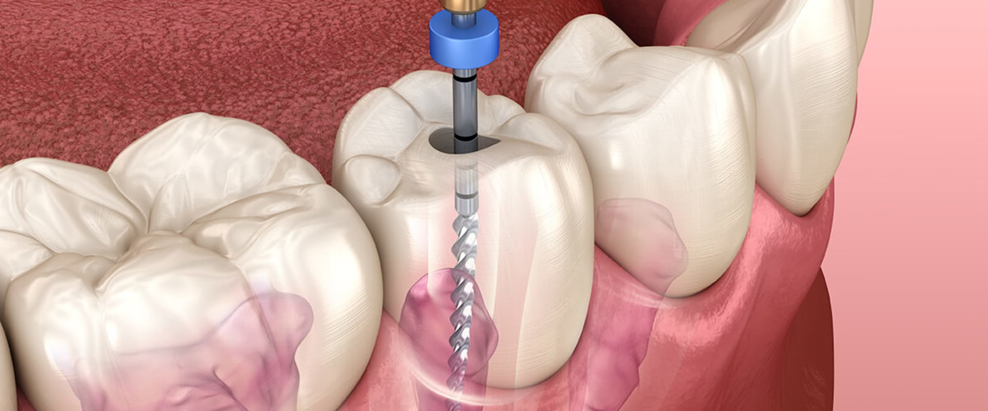 Diagnosis and Preparation for Root Canal Treatment