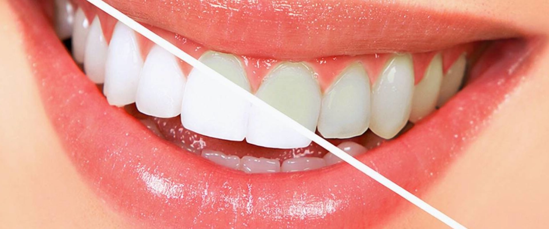 Take-home Teeth Whitening Treatments: A Comprehensive Overview