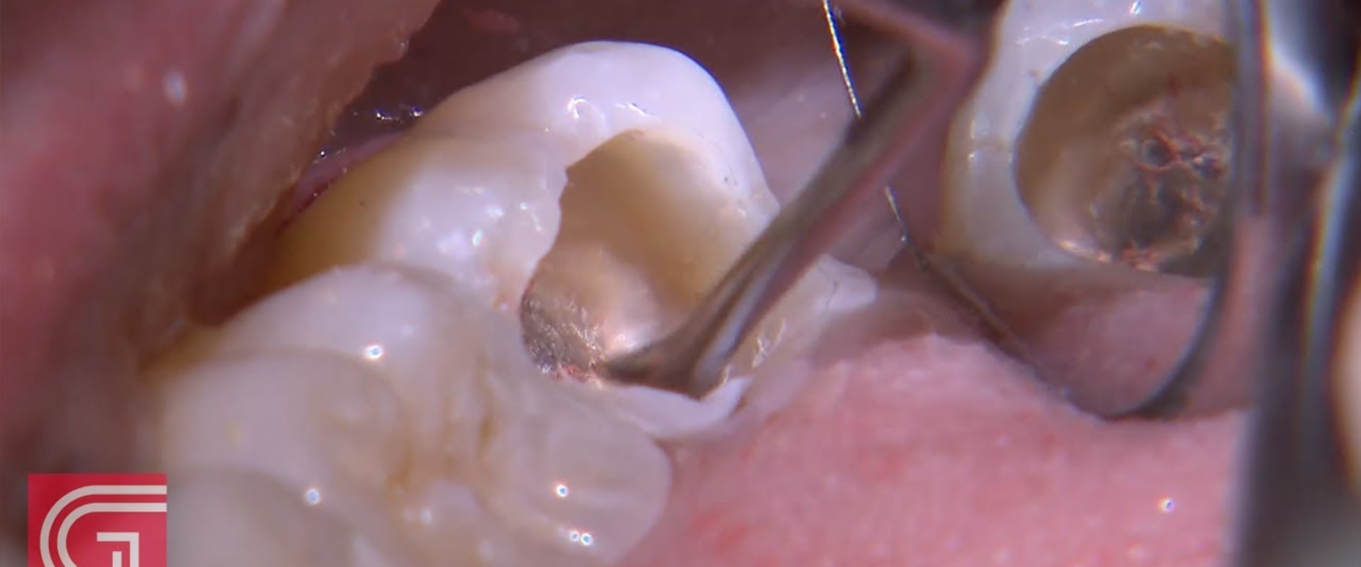 Cleaning the Inside of the Tooth: A Complete Overview