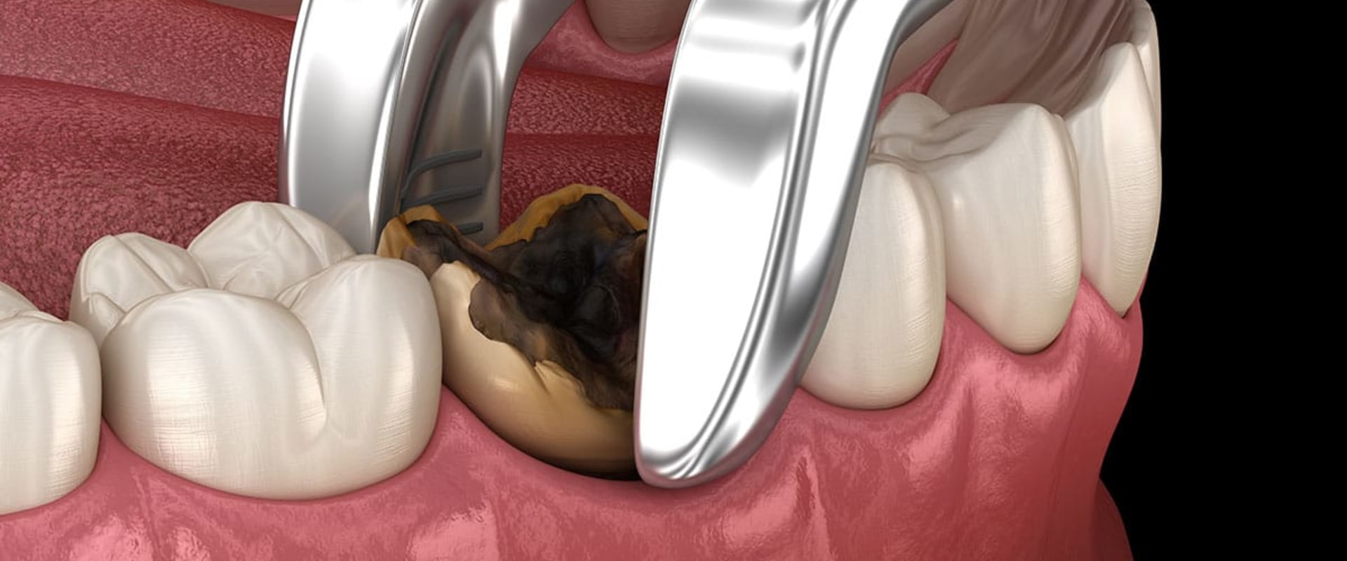 The Basics of Tooth Extractions