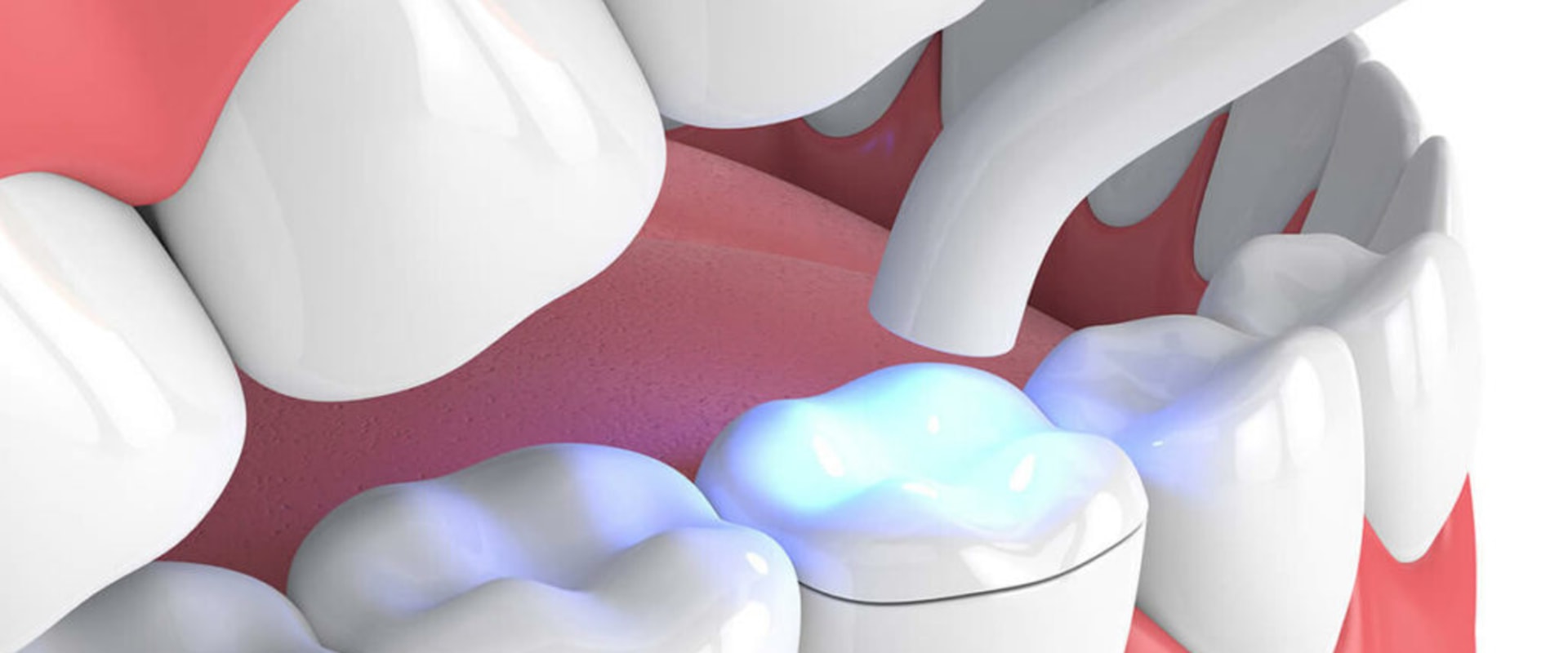 Fillings and Dental Inlays: A Comprehensive Overview