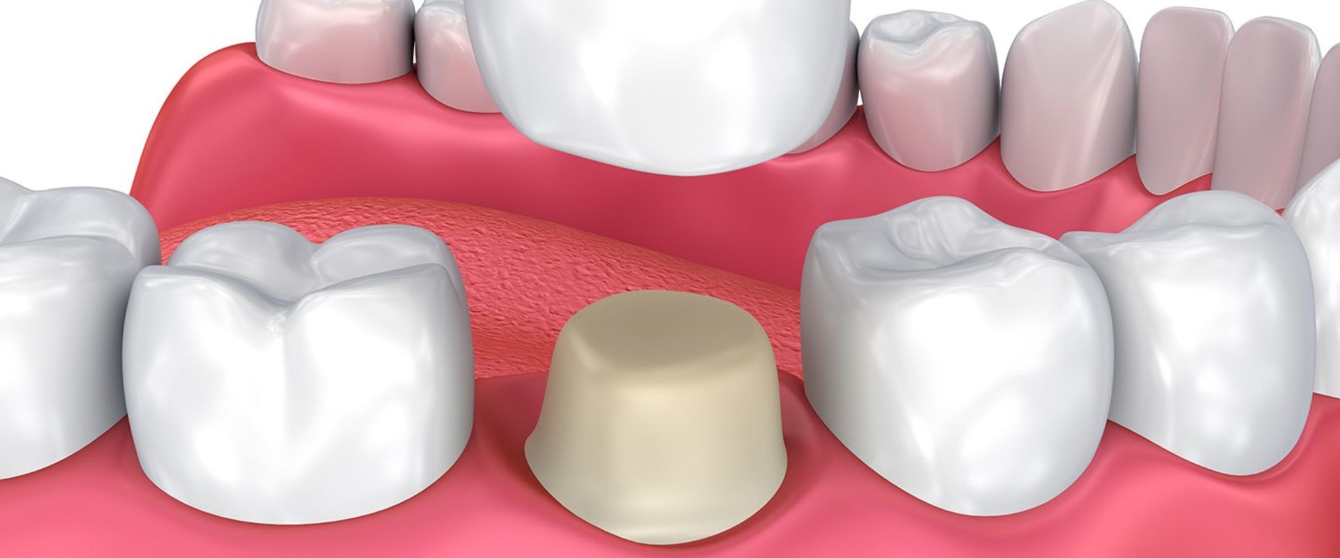 Restoring the Tooth with a Crown