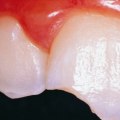 Everything You Need to Know About Injury or Trauma to the Tooth