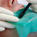 Caring for the Wound After a Root Canal Treatment