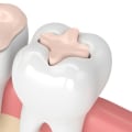 Everything You Need to Know About Fillings and Dental Inlays