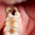 Severe Tooth Decay or Infection: Causes, Symptoms, and Treatment