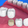 Everything You Need to Know About Crowns and Bridges