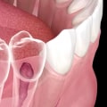Root Canals: Explaining the Procedure and Benefits