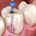 Diagnosis and Preparation for Root Canal Treatment