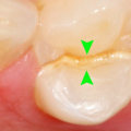 Everything you need to know about fractured or cracked tooth