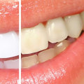 Teeth Whitening: A Comprehensive Overview