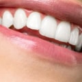 Teeth Whitening: Everything You Need to Know