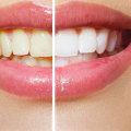 Laser Teeth Whitening Treatments: An In-Depth Look