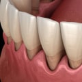 Gum Surgery: A Comprehensive Overview