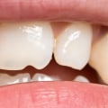 Broken or Severely Damaged Teeth: Causes and Treatment