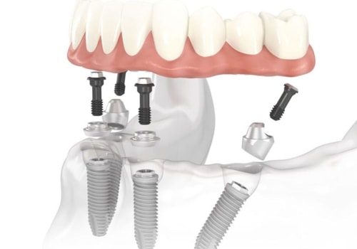 Dental Implants: Everything You Need to Know