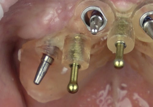 Placement of Dental Implants: A Comprehensive Overview