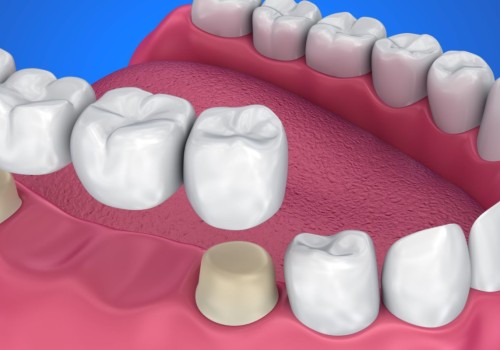 Everything You Need to Know About Crowns and Bridges