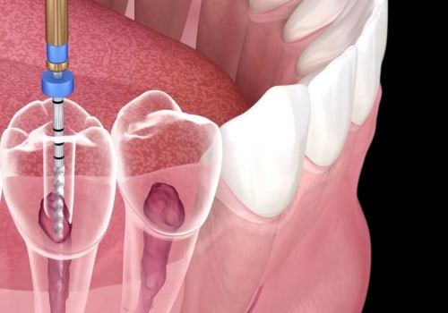 Root Canals: Explaining the Procedure and Benefits
