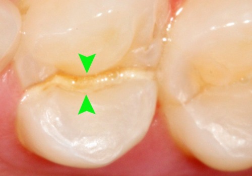 Everything you need to know about fractured or cracked tooth