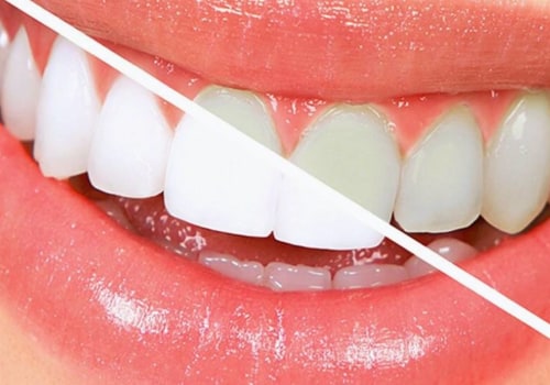 Take-home Teeth Whitening Treatments: A Comprehensive Overview