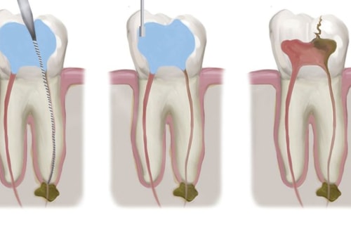 Root Canals: A Comprehensive Overview