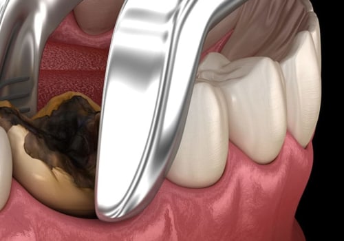Simple Tooth Extraction: All You Need To Know