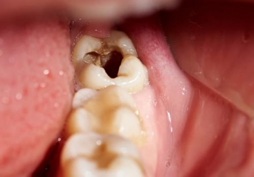 Tooth Decay or Infection: Causes, Prevention, and Treatments