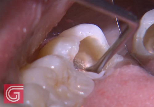 Cleaning the Inside of the Tooth: A Complete Overview