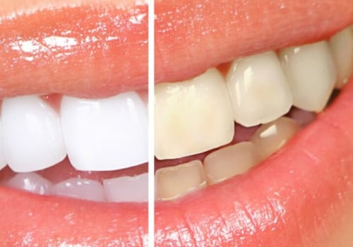 Teeth Whitening: A Comprehensive Overview