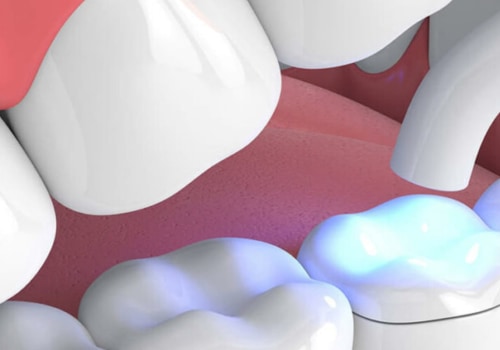 Fillings and Dental Inlays: A Comprehensive Overview