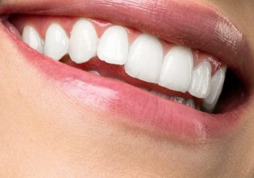 Teeth Whitening: Everything You Need to Know