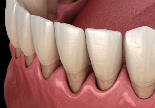 Gum Surgery: A Comprehensive Overview