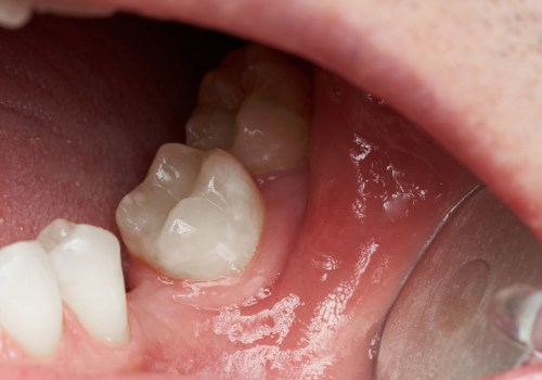 Missing Teeth: Causes, Treatment, and Prevention