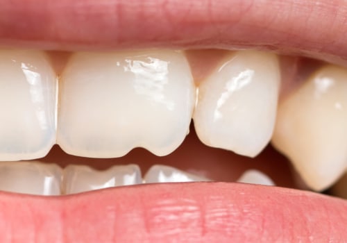 Broken or Severely Damaged Teeth: Causes and Treatment